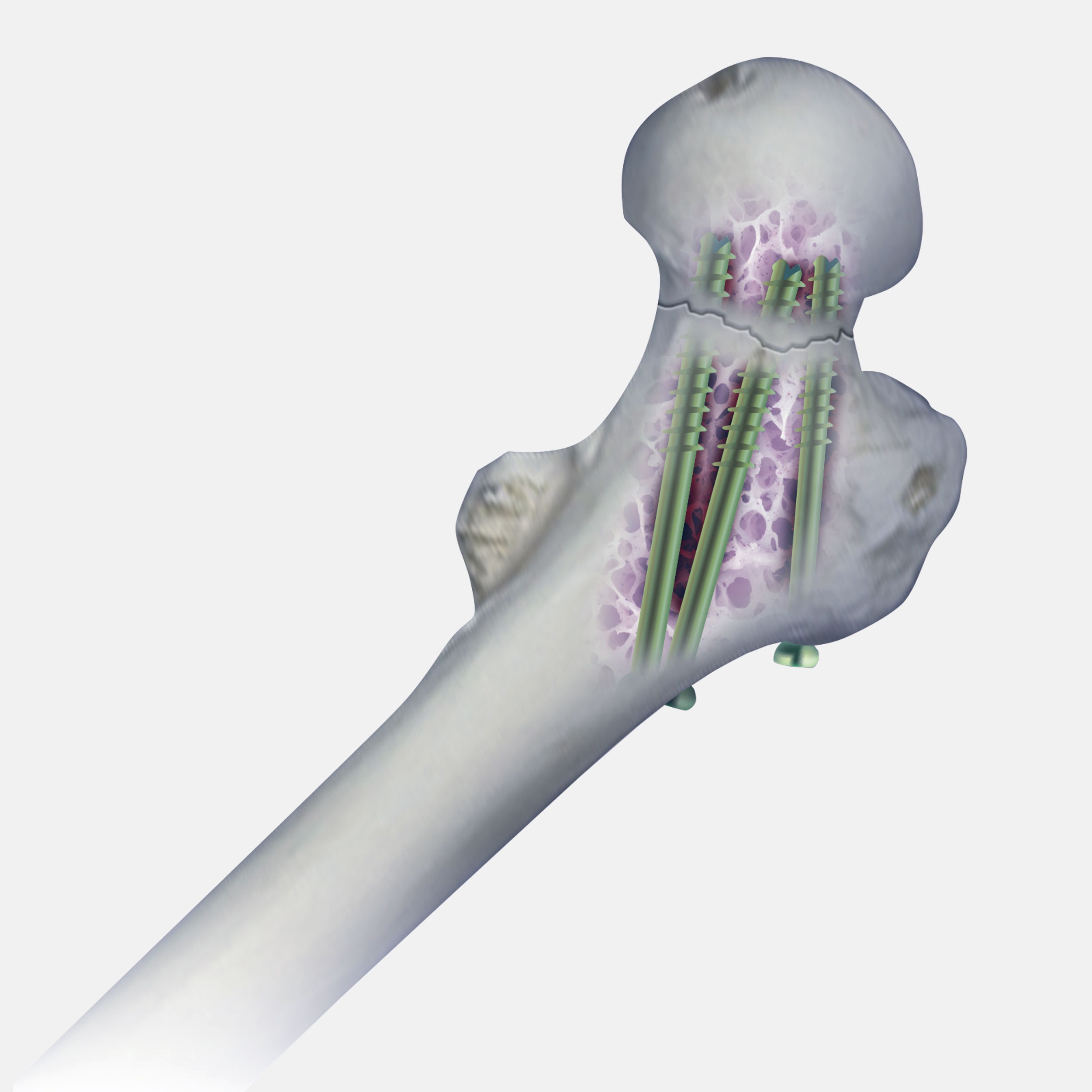 7,0 mm Kanüliertes Schraubensystem