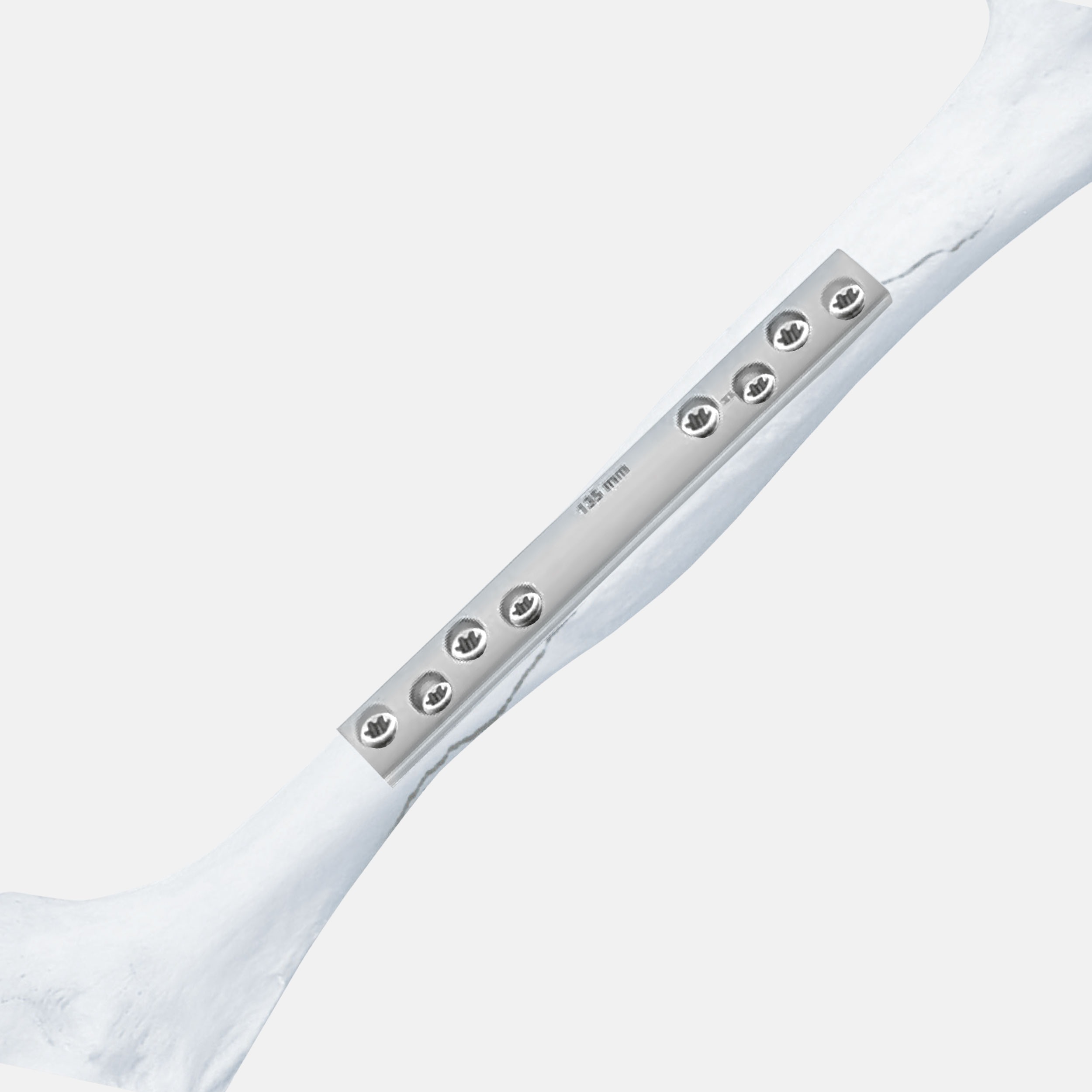 Large Fragment Instruments & Stainless Steel Implants