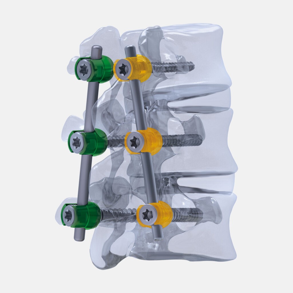 Spine | SiS medical Co., Ltd.
