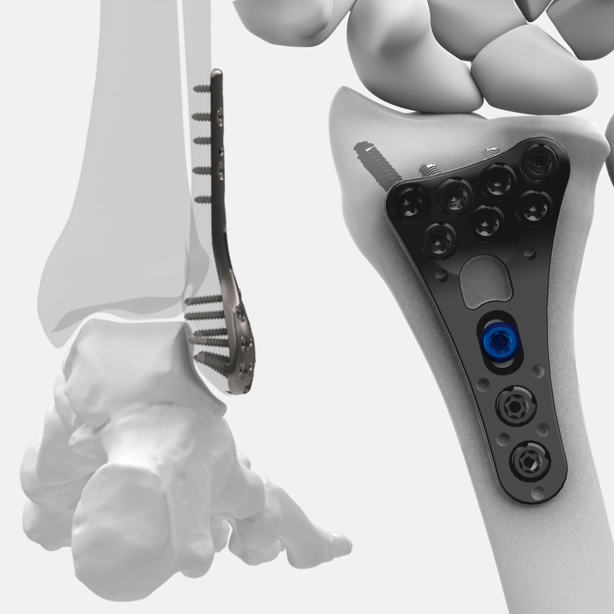 Distal Radius and Fibula Plates